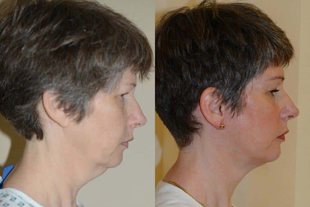 Facelift photos and neck liposuction