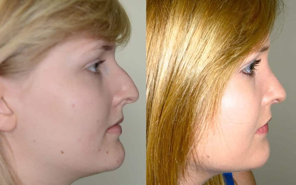 Septo-rhinoplasty – previous nasal fracture