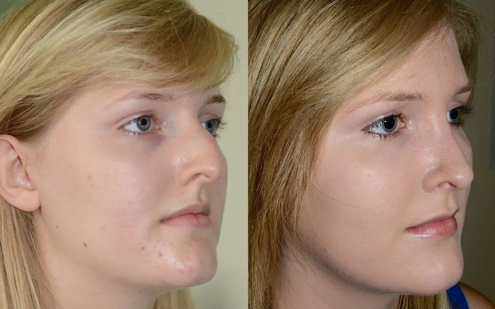 Septo-rhinoplasty – previous nasal fracture