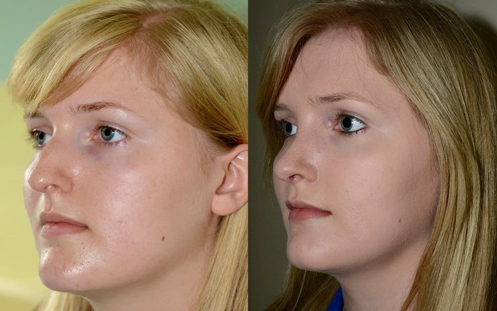 Septo-rhinoplasty – previous nasal fracture