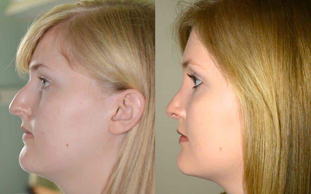 Septo-rhinoplasty – previous nasal fracture