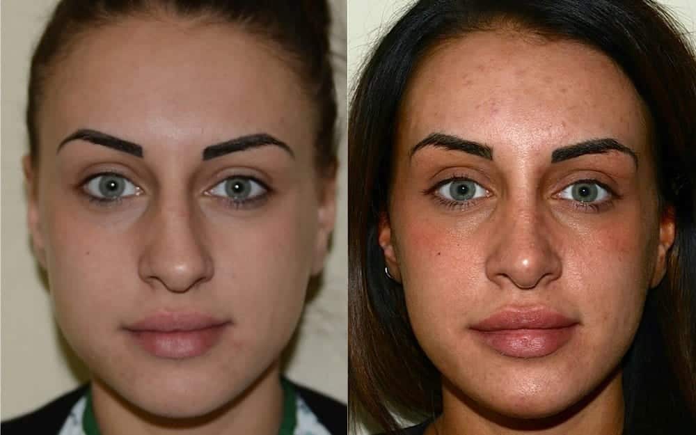 Septorhinoplasty with dorsal hump removal