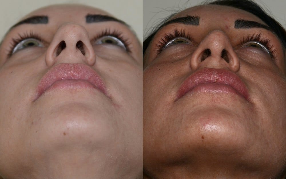 Septorhinoplasty with dorsal hump removal