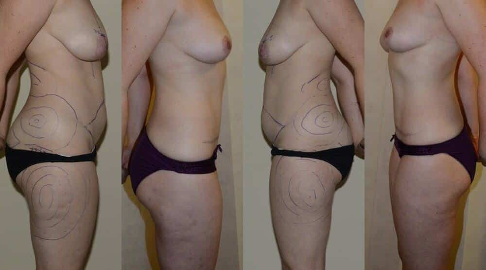 Tummy tuck, breast lift and extensive liposuction