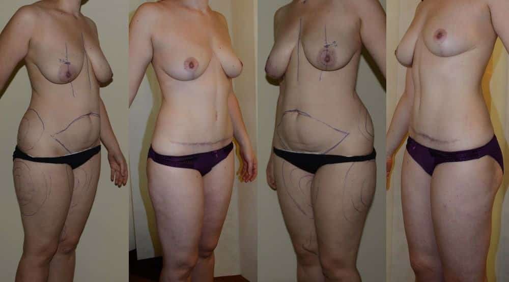 Tummy tuck with extensive trunk liposuction