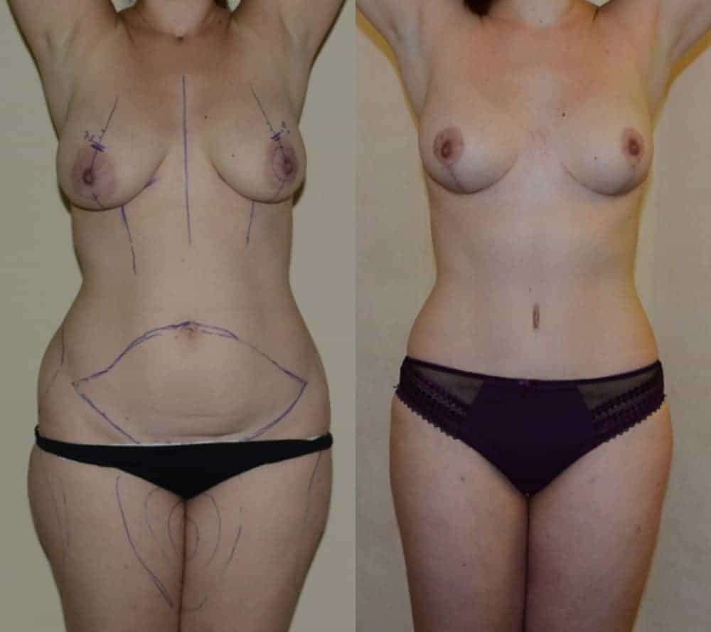 Tummy tuck, breast lift and extensive liposuction