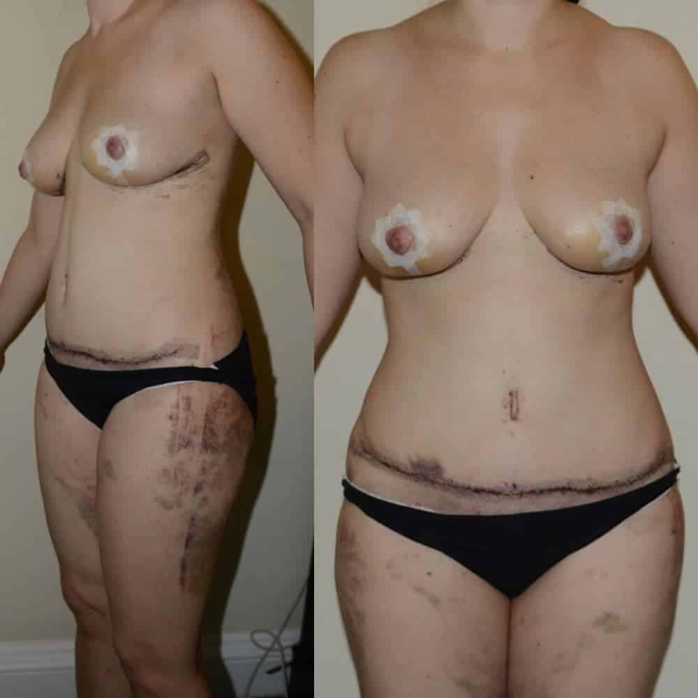 Tummy tuck, breast lift and extensive liposuction