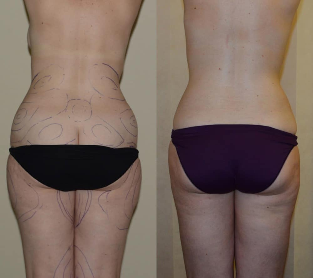 Liposuction to flanks, hips and thighs