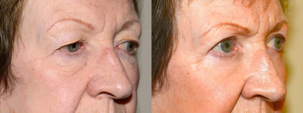 Upper and lower eyelid surgery