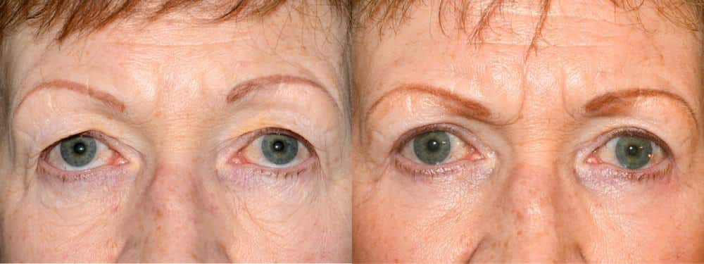 Upper and lower eyelid surgery