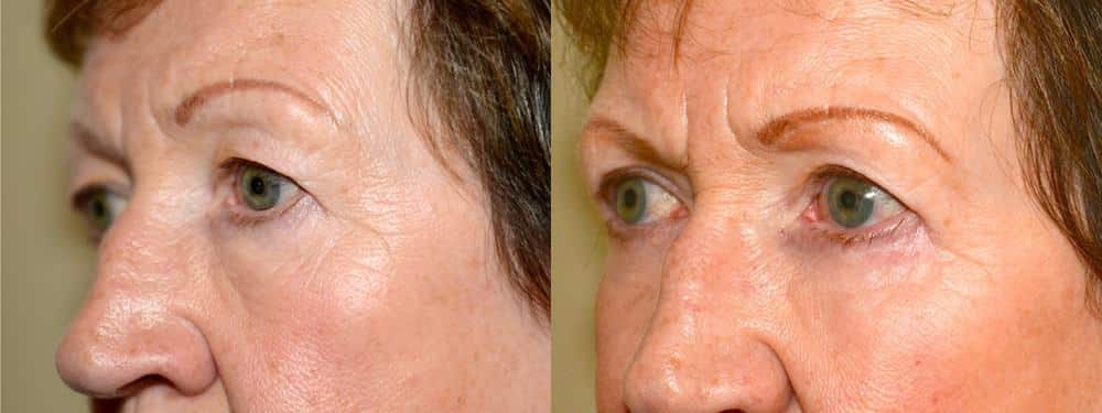 Upper and lower eyelid surgery