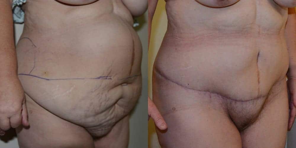 Tummy tuck with repair of a hernia after massive weight loss