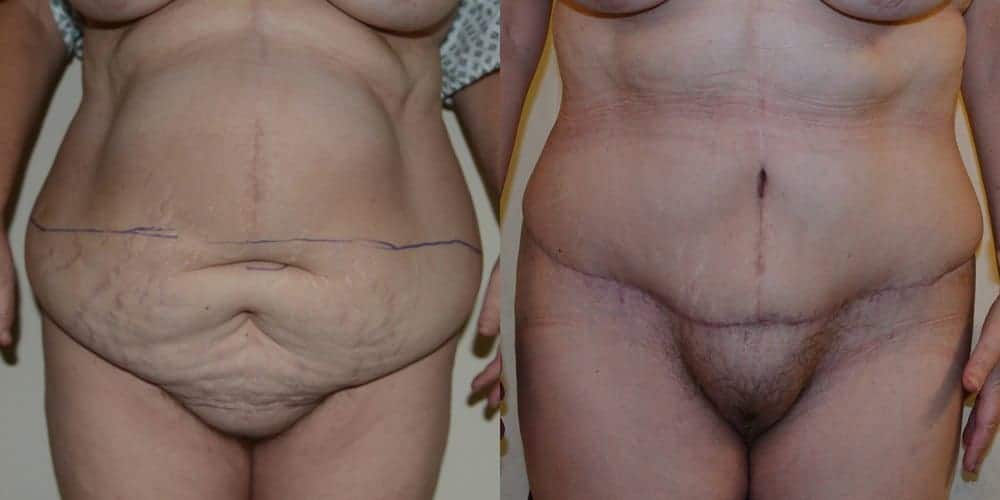 Tummy tuck with repair of a hernia after massive weight loss