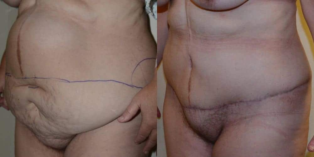 Tummy tuck with repair of a hernia after massive weight loss
