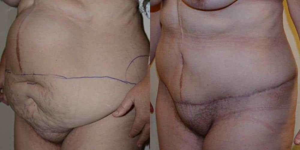 Tummy tuck with repair of a hernia after massive weight loss