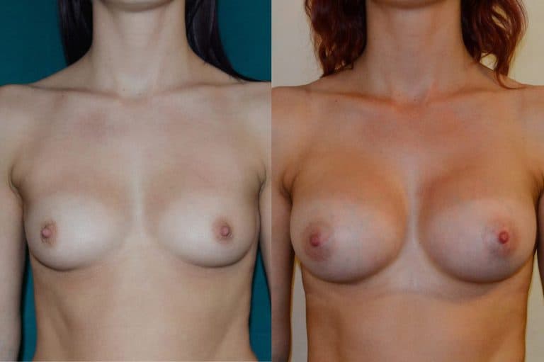 Breast augmentation before and after, case 33, photo 1 of 4