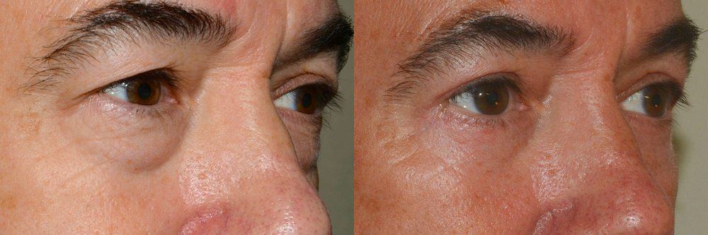 eyelid surgery photos uk