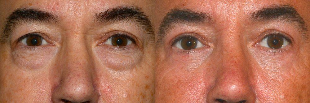 Upper blepharoplasty and removal of eye bag