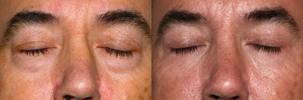 Upper blepharoplasty and removal of eye bag