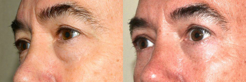 Upper blepharoplasty and removal of eye bag
