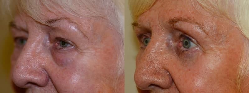 Upper and lower eyelid surgery with fat transfer