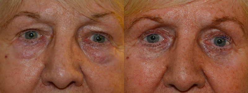 Upper and lower eyelid surgery with fat transfer