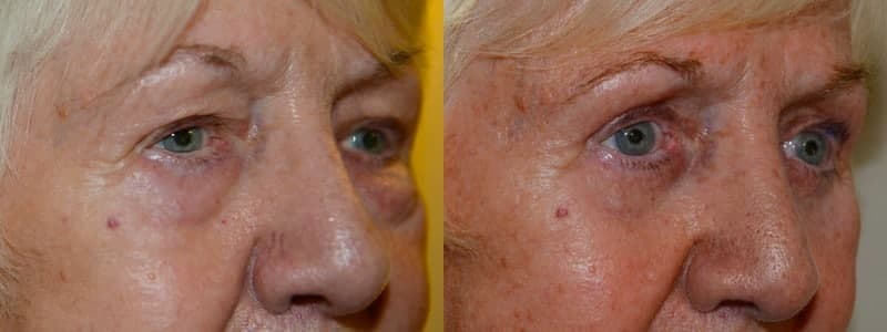 Upper and lower eyelid surgery with fat transfer