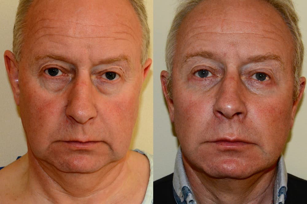 Male facelift, liposuction and fat transfer
