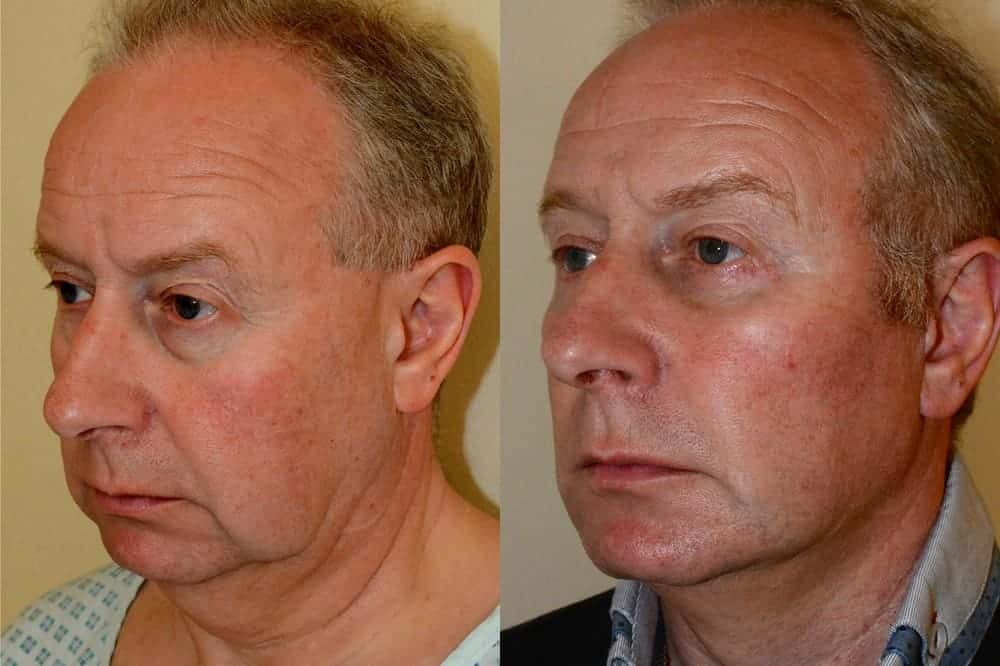 Male facelift, liposuction and fat transfer