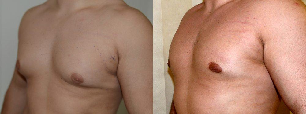 Gynaecomastia before and after