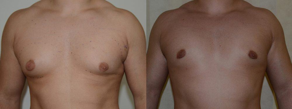 Gynaecomastia before and after