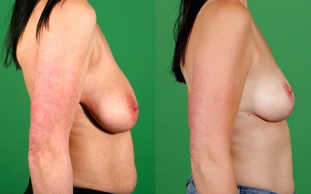 breast reduction/ mastopexy