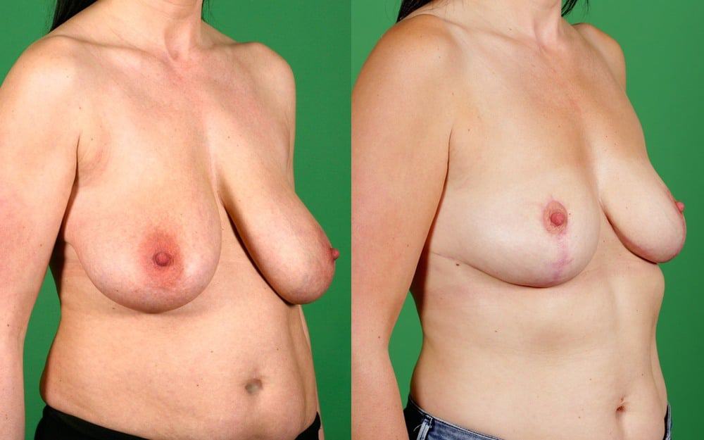 breast reduction/ mastopexy