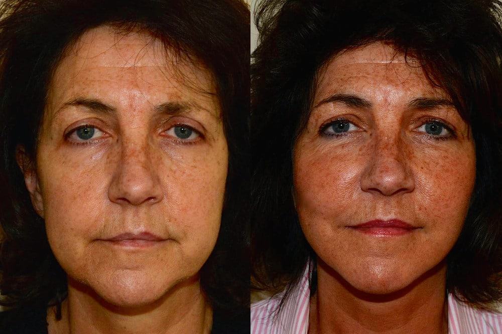 Lower neck/ facelift