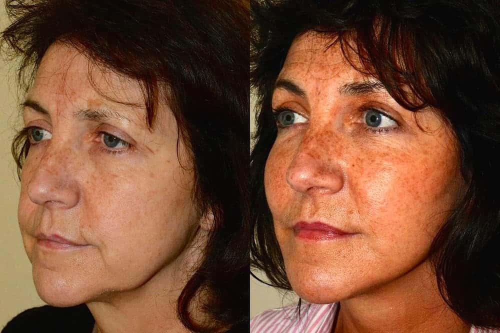 Lower neck/ facelift