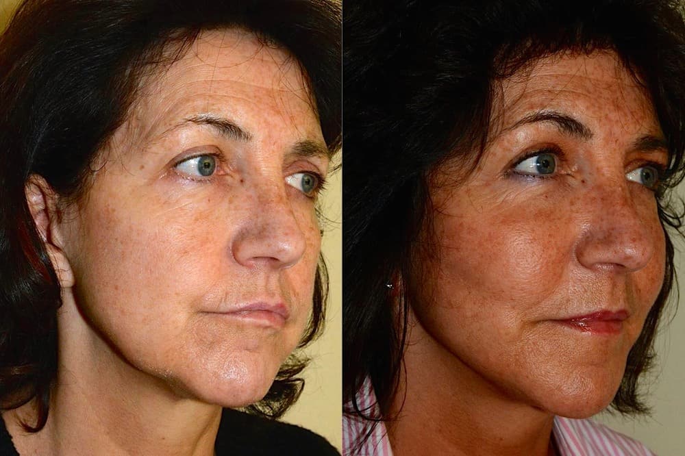 Lower neck/ facelift