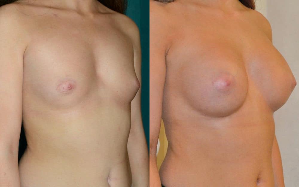 Breast implants