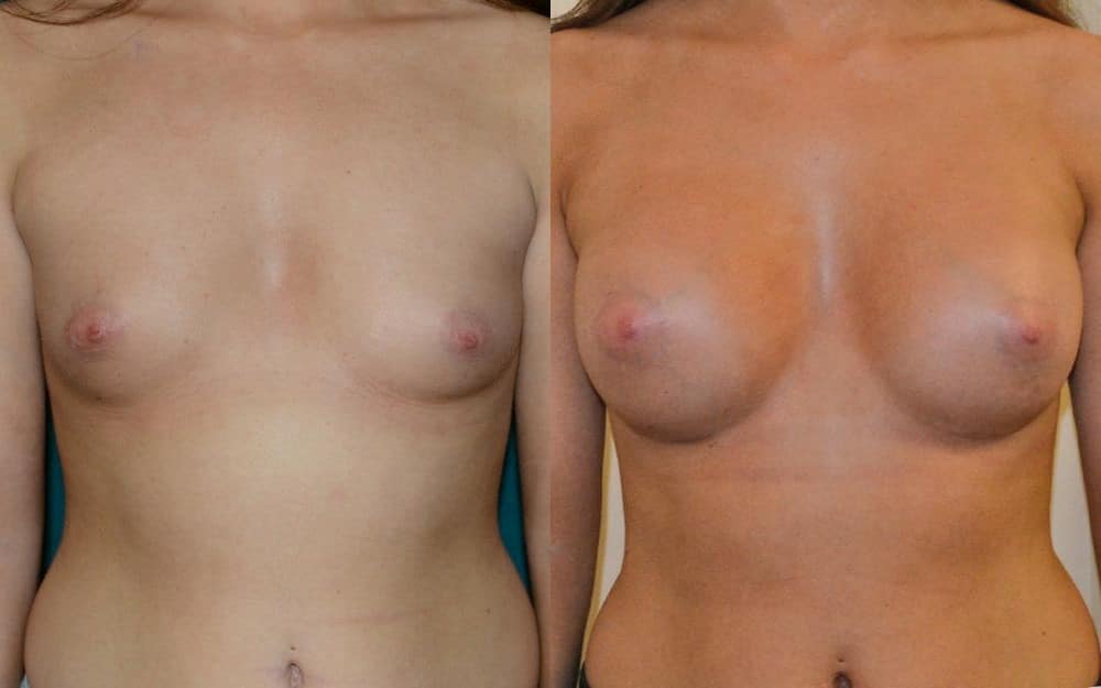 Breast implants
