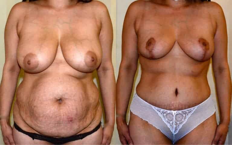 Body contouring before and after, photo 1 of 4