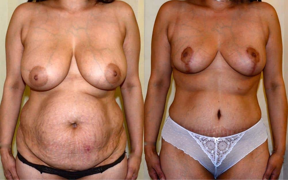 Breast lift with tummy tuck
