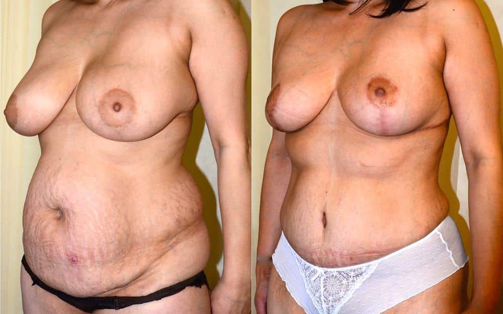 Breast lift with tummy tuck