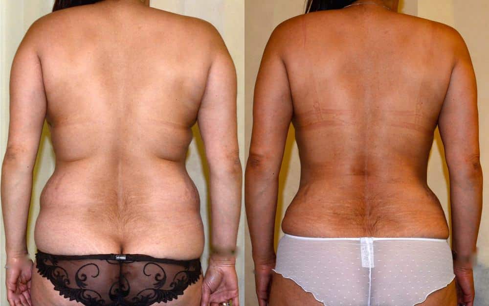 Tummy tuck with other procedures after bariatric surgery