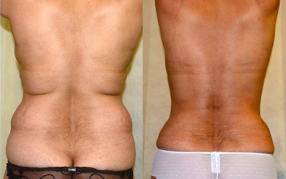 Waist and back liposuction