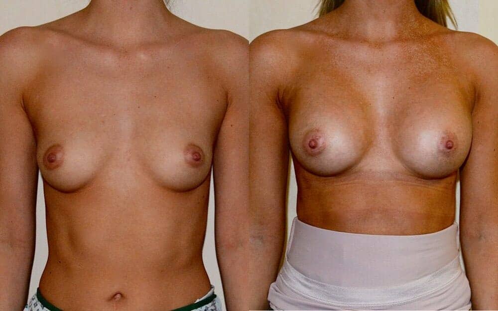Under the muscle breast augmentation
