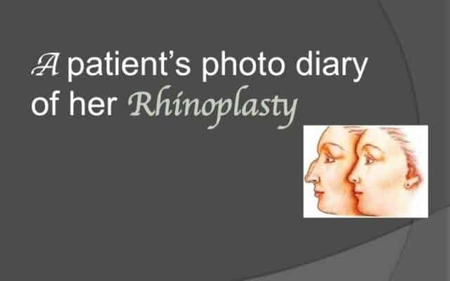 Diary of a rhinoplasty patient