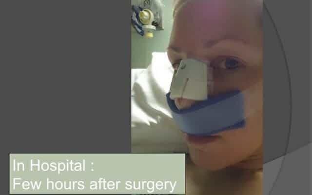 Diary of a rhinoplasty patient