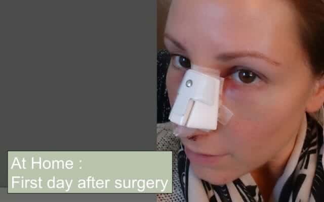 Diary of a rhinoplasty patient