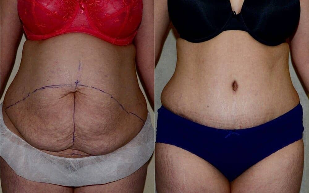 Tummy tuck photos with muscle tightening