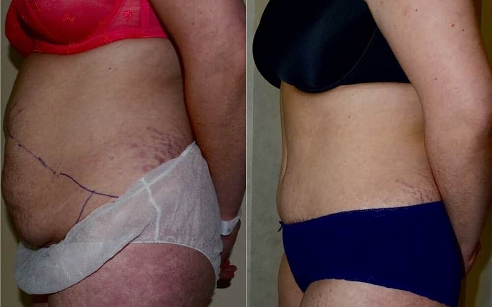 Tummy tuck photos with muscle tightening