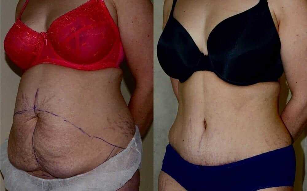 Tummy tuck photos with muscle tightening